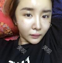 自體脂肪面部填充后我的部看上去好自然宛若天生