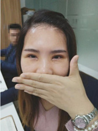 于利民醫(yī)生讓我基本和單眼皮說“拜拜”