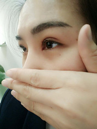 于利民醫(yī)生讓我基本和單眼皮說“拜拜”