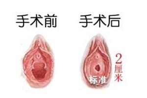 感謝范建輝醫(yī)生給我做的私密整形手術(shù)讓我又成功抓住了老公的心