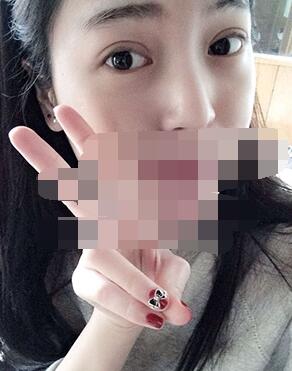 做埋線雙眼皮一周啦~果滿滿的！