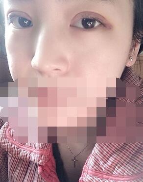 做埋線雙眼皮一周啦~果滿滿的！