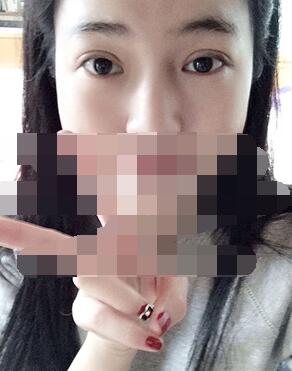 做埋線雙眼皮一周啦~果滿滿的！