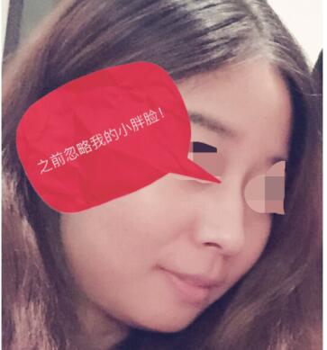 做了玻尿酸注射隆鼻 感覺很不錯