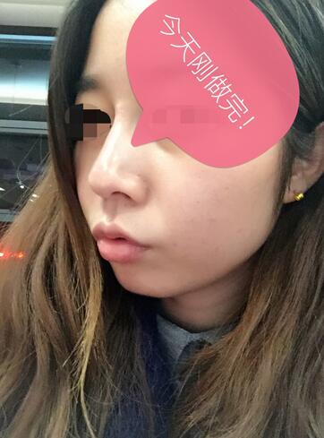 做了玻尿酸注射隆鼻 感覺很不錯