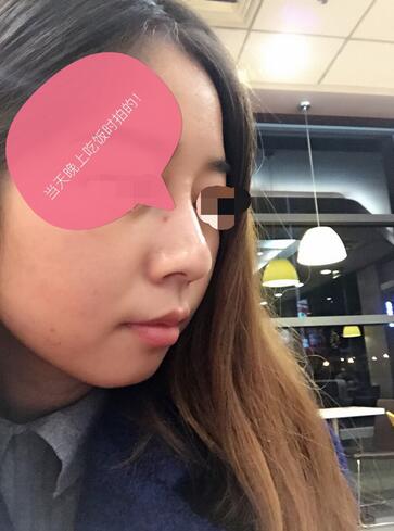 做了玻尿酸注射隆鼻 感覺很不錯