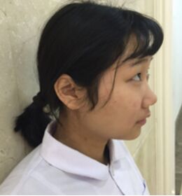 做了切開雙眼皮之后氣質(zhì)都不一樣了