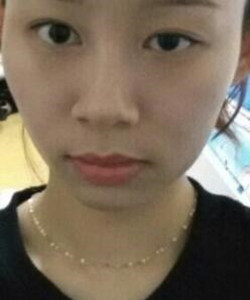 去北京301醫(yī)院整形美容科做了顴骨內(nèi)推大家快來(lái)圍觀啦