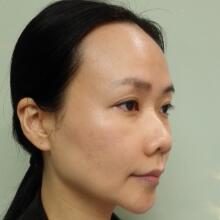 面b提升手術(shù)價(jià)格和真人案例