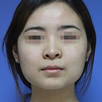 下頜角手術(shù)費(fèi)用和案例