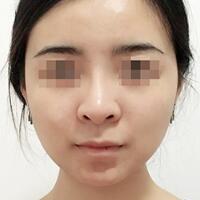 下頜角手術(shù)費(fèi)用和案例