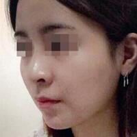 下頜角手術(shù)費(fèi)用和案例