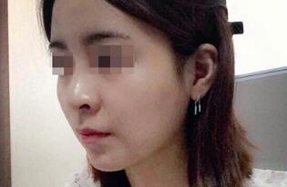 下頜骨削骨瘦臉整形手術(shù)真實案例多圖對比分享