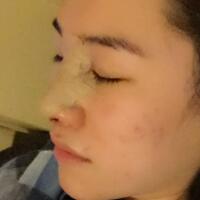 硅膠假體隆鼻和鼻翼縮小隆鼻整形花費(fèi)15800元