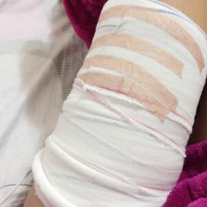 吸脂減肥瘦手臂，甩掉蝴蝶袖告別粗手臂真實(shí)案例分享