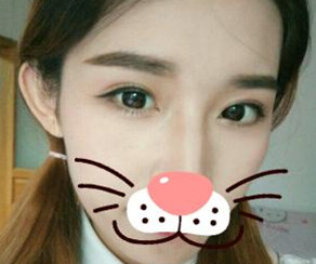 鄭東學(xué)做的雙眼皮果你來評價