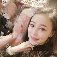 自體脂肪隆鼻之后恢復(fù)得很好果超自然的