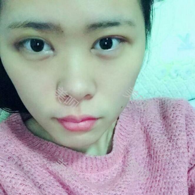 做了切開雙眼皮手術(shù)后的我愛上了自拍