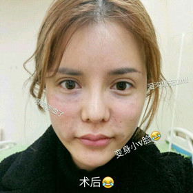 埋蛋白線.提升面部對比圖片，顏值嘩嘩嘩的往上漲!!!