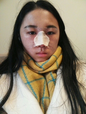 于立民醫(yī)生給我做的隆鼻整形手術(shù)，給大家分享我整形的過程吧!