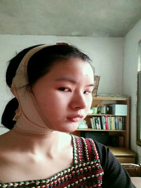 自體脂肪填充下巴前后對比圖，進來看看就知道啦!