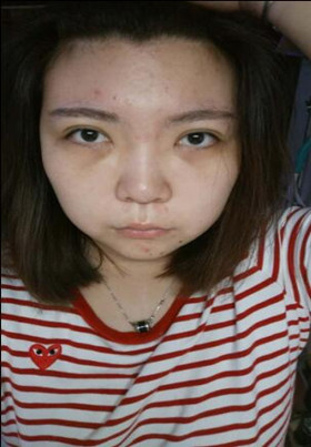 激光去眼袋后，整個人都年輕了不少啊!