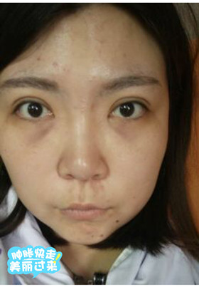 激光去眼袋后，整個人都年輕了不少啊!