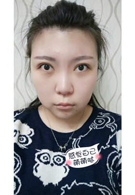 激光去眼袋后，整個人都年輕了不少啊!