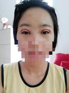 8.15號割的雙眼皮 感謝慕醫(yī)生