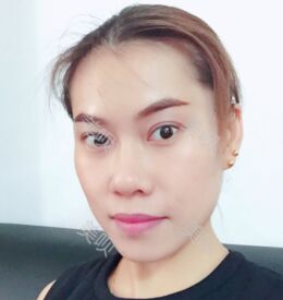 埋埋蛋白線.提升后皮膚緊致了不少也更年輕了