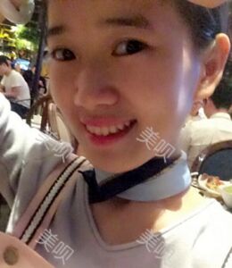 全切雙眼皮帶給我超自然的美麗雙眼