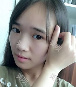 全切雙眼皮帶給我超自然的美麗雙眼