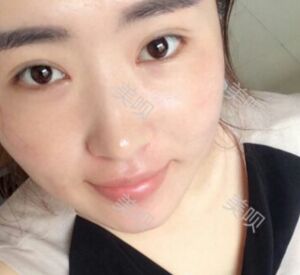 煙臺鵬愛做的雙眼皮宛如天生