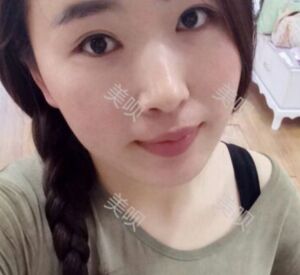 煙臺鵬愛做的雙眼皮宛如天生