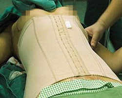 我在北京藝星醫(yī)療美容醫(yī)院自體脂肪隆胸真實(shí)經(jīng)歷