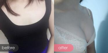 假體隆胸前后對比圖