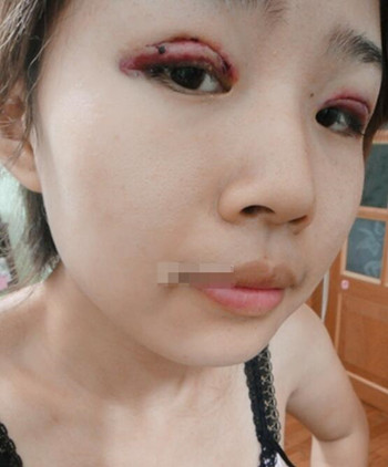 你們來看看藝美門智和做的埋線雙眼皮，瞬間變大眼美女