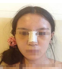 藝美門智和綜合隆鼻，你值得擁有