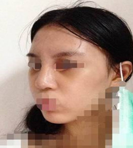 藝美門智和綜合隆鼻，你值得擁有