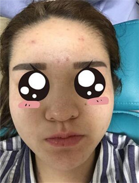 杜姜給我打了水光補水看起來皮膚嫩嫩的