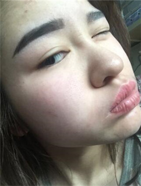 杜姜給我打了水光補水看起來皮膚嫩嫩的