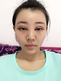 開外眼角手術(shù)前后過(guò)程對(duì)比圖片