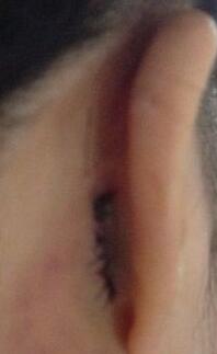 耳軟骨隆鼻前后過(guò)程圖片，見證我變美的過(guò)程