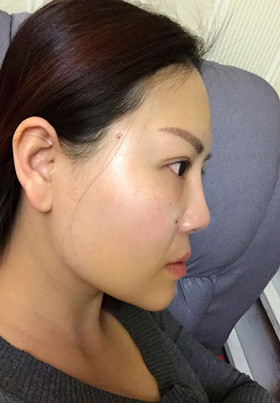 自體脂肪填充面部前后對比圖片，真的美了美了!