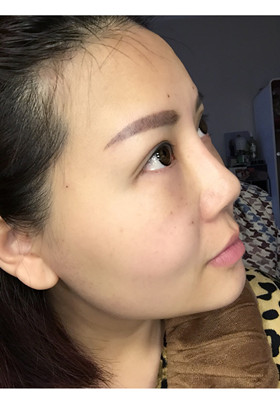 自體脂肪填充面部前后對比圖片，真的美了美了!