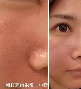 成都玉之光激光嫩膚經(jīng)歷 愛(ài)美的MM一定要看