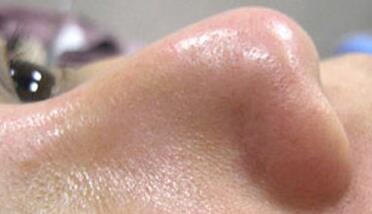 成都玉之光做了杏仁酸換膚 皮膚真的凈白無(wú)瑕了