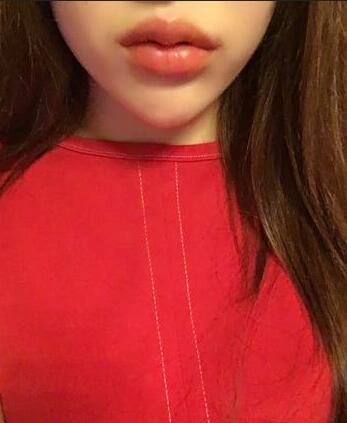 北京禾美嘉注射玻尿酸豐唇+豐臥蠶 讓我更美啦~