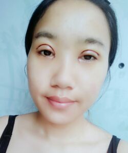 煙臺鵬愛魏璐做的全切雙眼皮，我也是大眼美女了