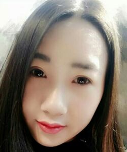 煙臺鵬愛魏璐做的全切雙眼皮，我也是大眼美女了